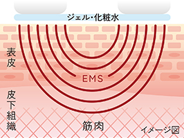 イメージ:EMS