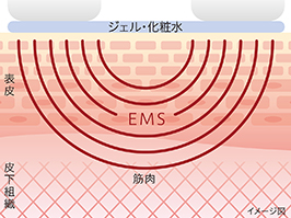 イメージ:EMS